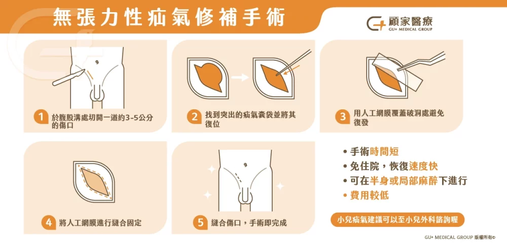 無張力疝氣修補手術介紹