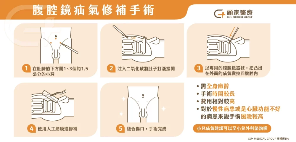 腹腔鏡疝氣修補手術介紹