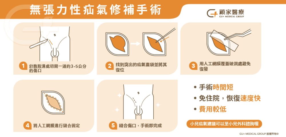 無張力疝氣修補手術
