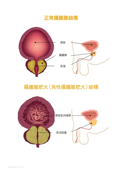 攝護腺肥大長怎樣