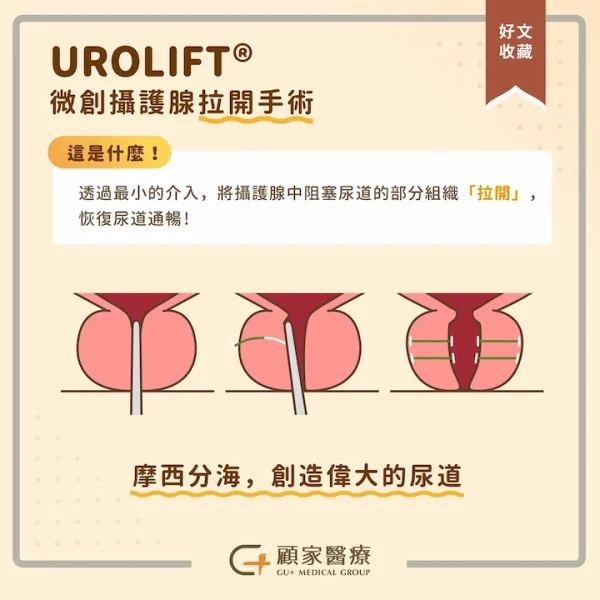 UROLIFT 微創攝護腺拉開手術