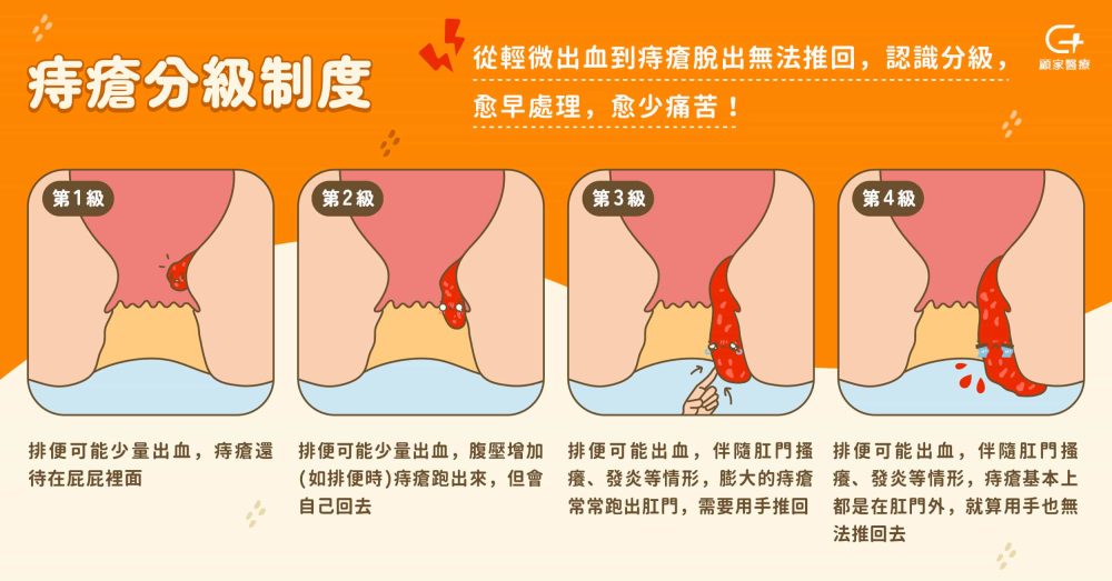 痔瘡分級