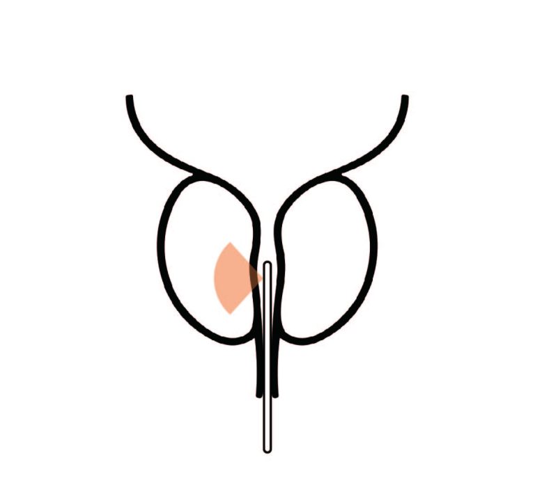 攝護腺綠光雷射