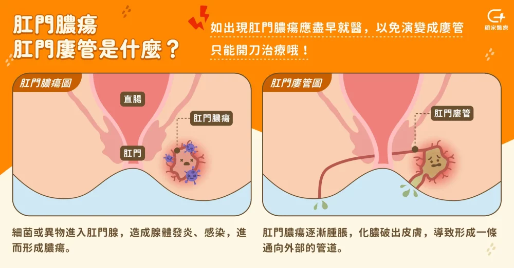 肛門膿瘍肛門廔管是什麼？