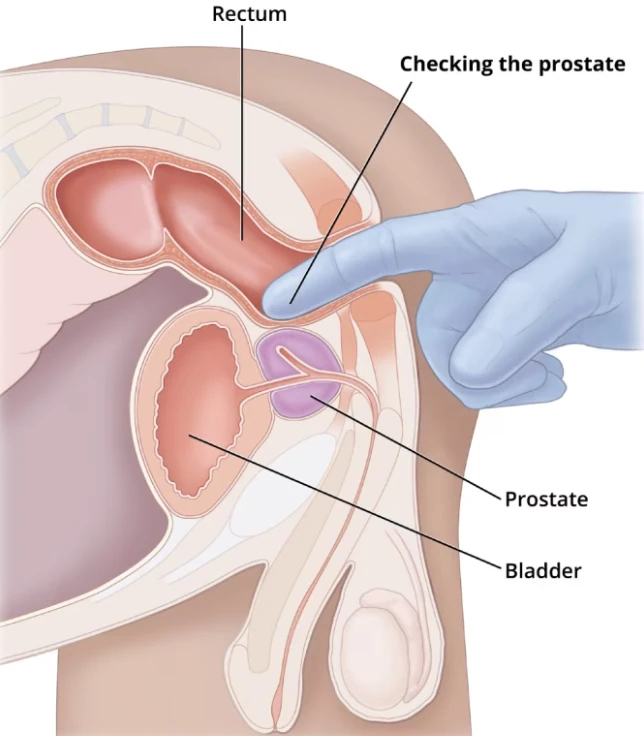 攝護腺肛門指診
