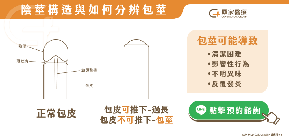 包皮過長要開刀嗎?如何辨認是不是包莖?割包皮找顧家醫療
