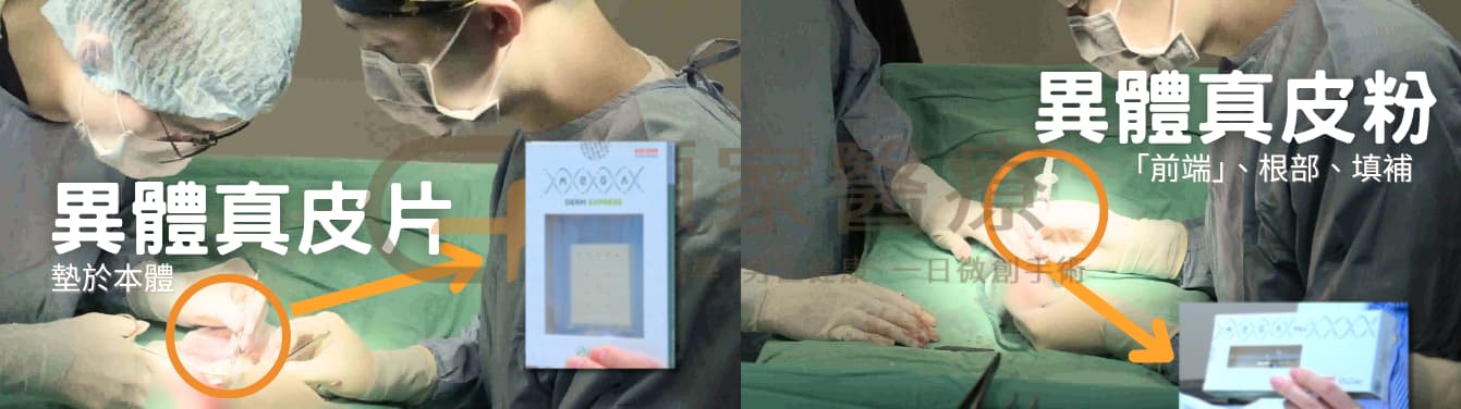 異體真皮材質是什麼