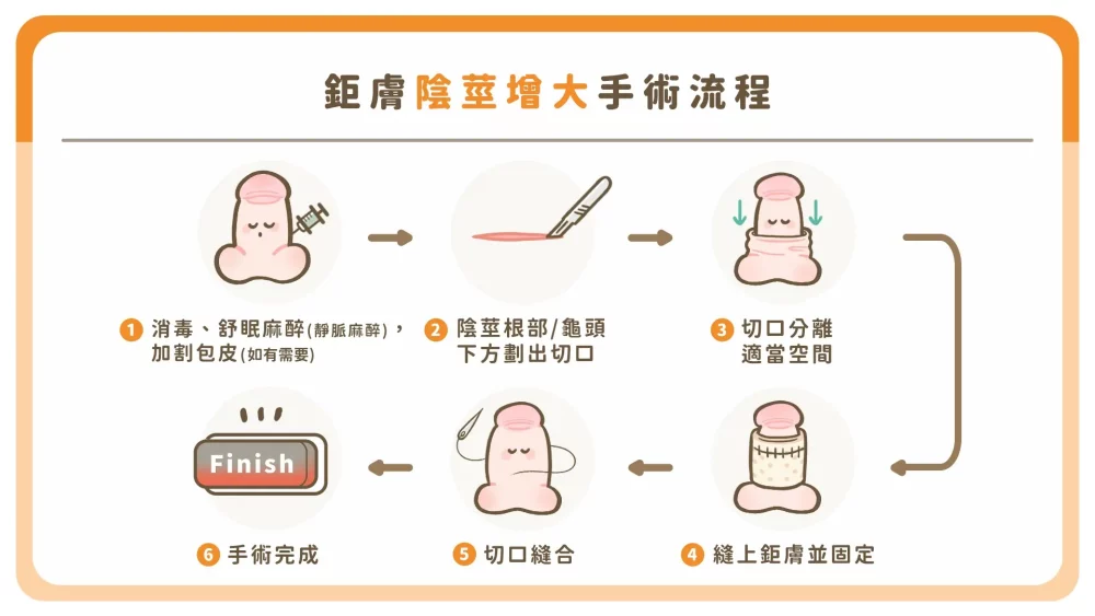 顧家醫療鉅膚陰莖增大手術流程