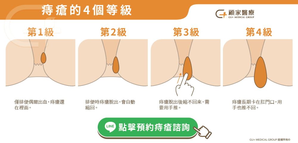 痔瘡嚴重度四個等級