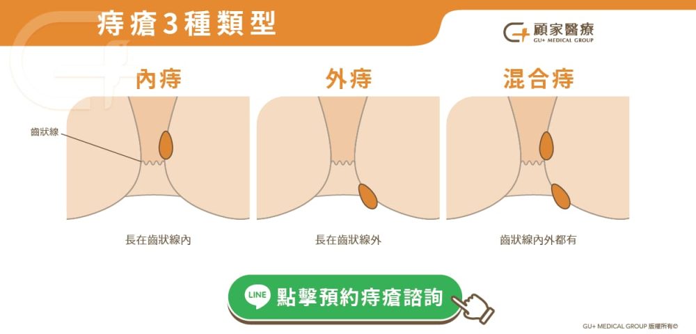常見痔瘡3種類型
