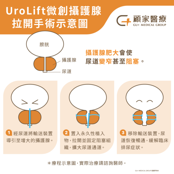 UroLift微創攝護腺拉開手術示意圖